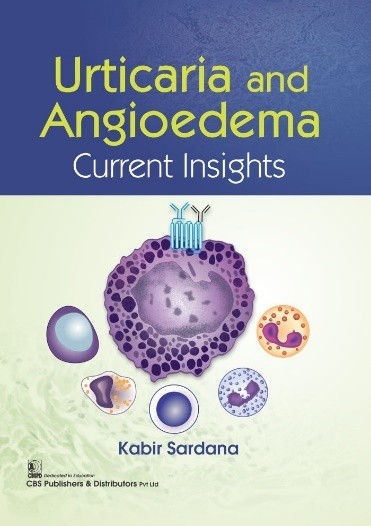 Urticaria and angioedema current insights